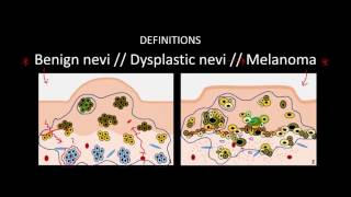 Introduction to Skin Cancer 3 Overview of Nevi and Melanoma [upl. by Les]