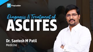 Diagnosis amp Treatment of Ascites by Dr Santosh M Patil [upl. by Ahsilek]