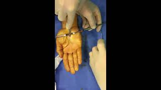 About 5 minutes carpal tunnel surgery [upl. by Odnavres]