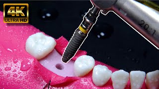 IMPRESIONANTE proceso del implante dental en 4K [upl. by Chery]