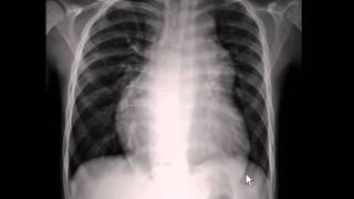 Chest xray  pulmonary arterial hypertension [upl. by Durston]