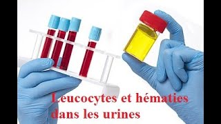 Infections urinaires  2 Pyélonéphrite aiguë  échographie [upl. by Acimad]