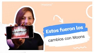 Opiniones Moons  Daniela comparte cómo vio los cambios en sus dientes usando Moons [upl. by Assinna]