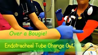 ET Tube Change Out Over a Bougie [upl. by Clapp282]