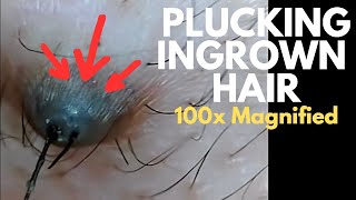 See How Ingrown Hair Gets Plucked at 100x Magnified Thick black hair with long wet amp slimy root [upl. by Virgel879]