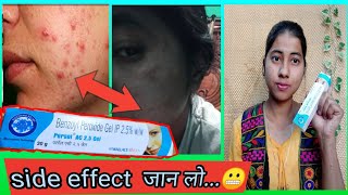 Benzoyl Peroxide Gel 25 Review In Hindi  Uses And Side Effect  miss glossy girl [upl. by Nelram]