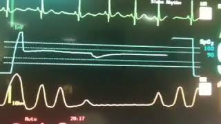 Cheyne Stokes Respiration recorded on cardiac monitor [upl. by Netsirt]