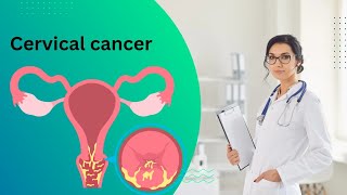 Cervical cancer सर्वाइकल कैंसर एक महत्वपूर्ण जानकारी cervix cervicalcancerawareness [upl. by Maloney882]