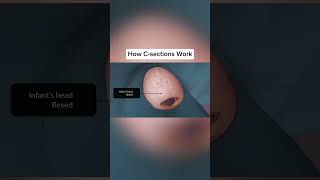 How a CSection Works A Comprehensive Overview pregnancy childbirth csection surgicaldelivery [upl. by Ulyram400]