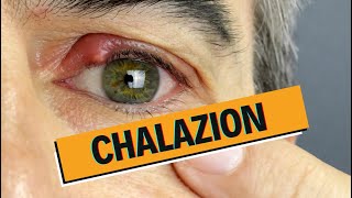 Chalazion et Orgelet  comment les soigner [upl. by Pomcroy]