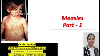 Measles  Virus etiopathogenesis clinical features  Pediatrics  NEET PG Shots by Dr Anshu [upl. by Yeargain85]