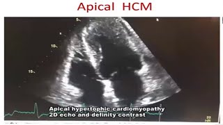 Cardiomyopathy Echo by Prof Dr Tuhin Haque madam [upl. by Dympha]