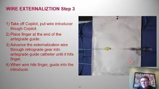 Guidewire externalization Stepbystep  Tony Doing MD [upl. by Attevaj]