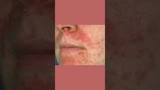 Why Your Perioral Dermatitis Won’t Heal dermatologist [upl. by Yenroc565]