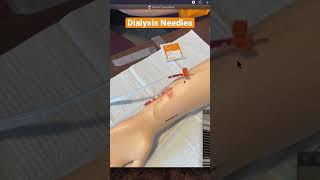 Mastering Dialysis  Learn How To Insert Needles For AV Fistula [upl. by Eenet467]