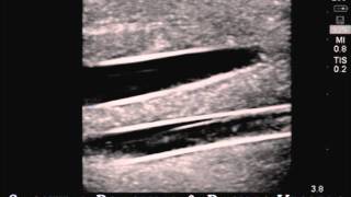 PICC Arterial Line and IV Ultrasound Model [upl. by Annohsat]