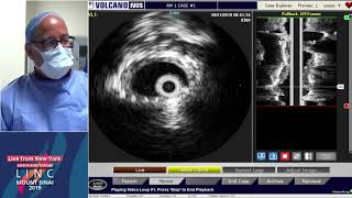 Hatch LC1 Left Lower Extremity Venogram IVUS and Possible Intervention  Dr Lookstein [upl. by Eixel]