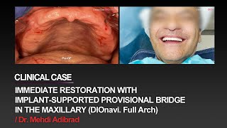 Immediate restoration with DIOnavi Full Arch [upl. by Akiv]