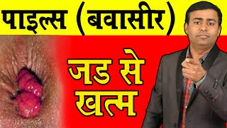 पाइल्स करे जड़ से ख़त्म piles cure by homeopathy I Piles cause symptoms treatment hindi piles [upl. by Dogs534]