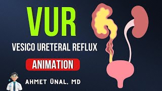 🎬 VUR Vesico Ureteral Reflux CLASSIFICATION amp ANIMATION [upl. by Eneryc]