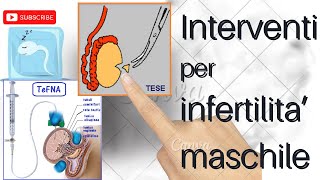 INFERTILITA MASCHILE PRELIEVO SPERMATOZOI CON INTERVENTO DI TESE O TEFNA [upl. by Vasily22]