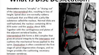 Disc Desiccation [upl. by Oiramat]