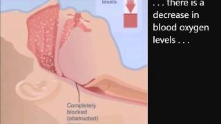 How CPAP works 52311wmv [upl. by Vasos]