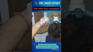 Supercharge Your Results PRP After Hair Transplant atriclinic shorts hairtransplant [upl. by Toth]