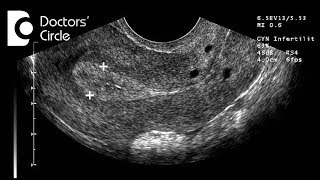 Is pregnancy possible with normal endometrial lining in follicular study  Dr Shefali Tyagi [upl. by Werner]