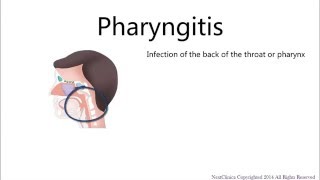 Viral pharyngitis [upl. by Einahteb515]