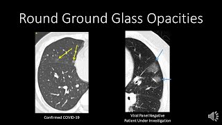 COVID19 CT Findings [upl. by Chucho187]