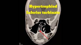 Hypertrophied Inferior Turbinate  ct pns radiology [upl. by Telocin]