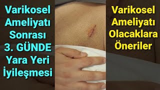 Varikosel Ameliyatı Sonrası Yara Yeri İyileşmesi Varikosel Ameliyatı Olacak Hastalara Öneriler [upl. by Emad712]