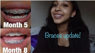 Braces update  Month 47 [upl. by Kramnhoj]