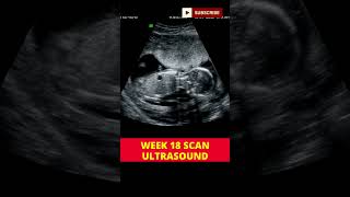 week 18 ultrasound scan  pregnancy week by week  3d scan [upl. by Higley796]