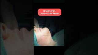 Under Chin Liposuction  Under Chin Fat Removal  Chin Liposuction Before After SB Aesthetics [upl. by Laekim]