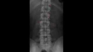 Lumbar Spine Radiology Tutorial [upl. by Adabel]