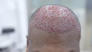 Hair Transplant Surgery in Forehead  full Surgical Video [upl. by Ycam]