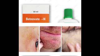 Betnovate N cream Betnovate N lotionBetnovate N Ointment Uses and side Effects in Urdu handi [upl. by Niwrehs605]