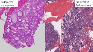 GYN Pathology Basics Endometrial Hyperplasia to Endometrioid Adenocarcinoma [upl. by Eyllib294]