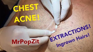 Chest congestionblackheads whiteheads ingrown hairs Multiple plugs extracted patient left happy [upl. by Asnerek]