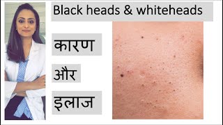 blackheads whiteheads treatment  ब्लाक हेड्ज़ को कैसे निकाले  त्वचा के डॉक्टर [upl. by Sutsugua]