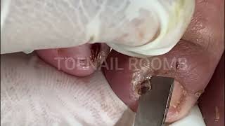 Toenail ASMR and Pedicure DIY Toenail ASMR and Pedicure DIY 479 [upl. by Orin947]