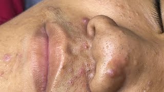 ACNE TREATMENT VU QUYNH MI  Blackheads Chin amp Nose Of Tweens 2024 FULL [upl. by Yesac]