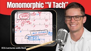 Monomorphic Ventricular Tachycardia VT EKG  ECG Lecture [upl. by Anigger]