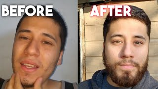 My Minoxidil Beard Journey Is Officially Complete  One Year After Stopping [upl. by Ivatts]