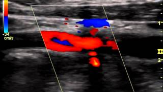 Internal Carotid Occlusion with Recanalizationwmv [upl. by Aihc899]