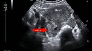 Ectopic Pregnancy Ultrasound Annotated JETem 2017 [upl. by Tobi]