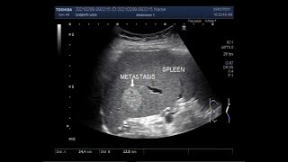 Umbilical Hernia and Splenic lesionMetastasis [upl. by Auqcinahs792]