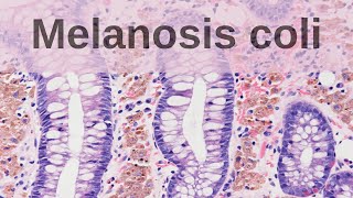 What is Melanosis Coli  Pathology mini tutorial [upl. by Ardnuas]